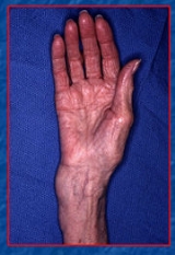 Distal+radius+fracture+splint