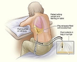 Pleurisy