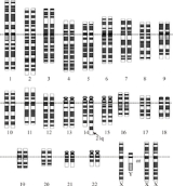 Robertsonian translocation